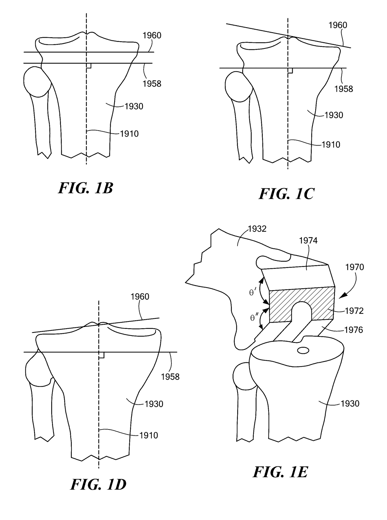 Patient Selectable Joint Arthroplasty Devices and Surgical Tools