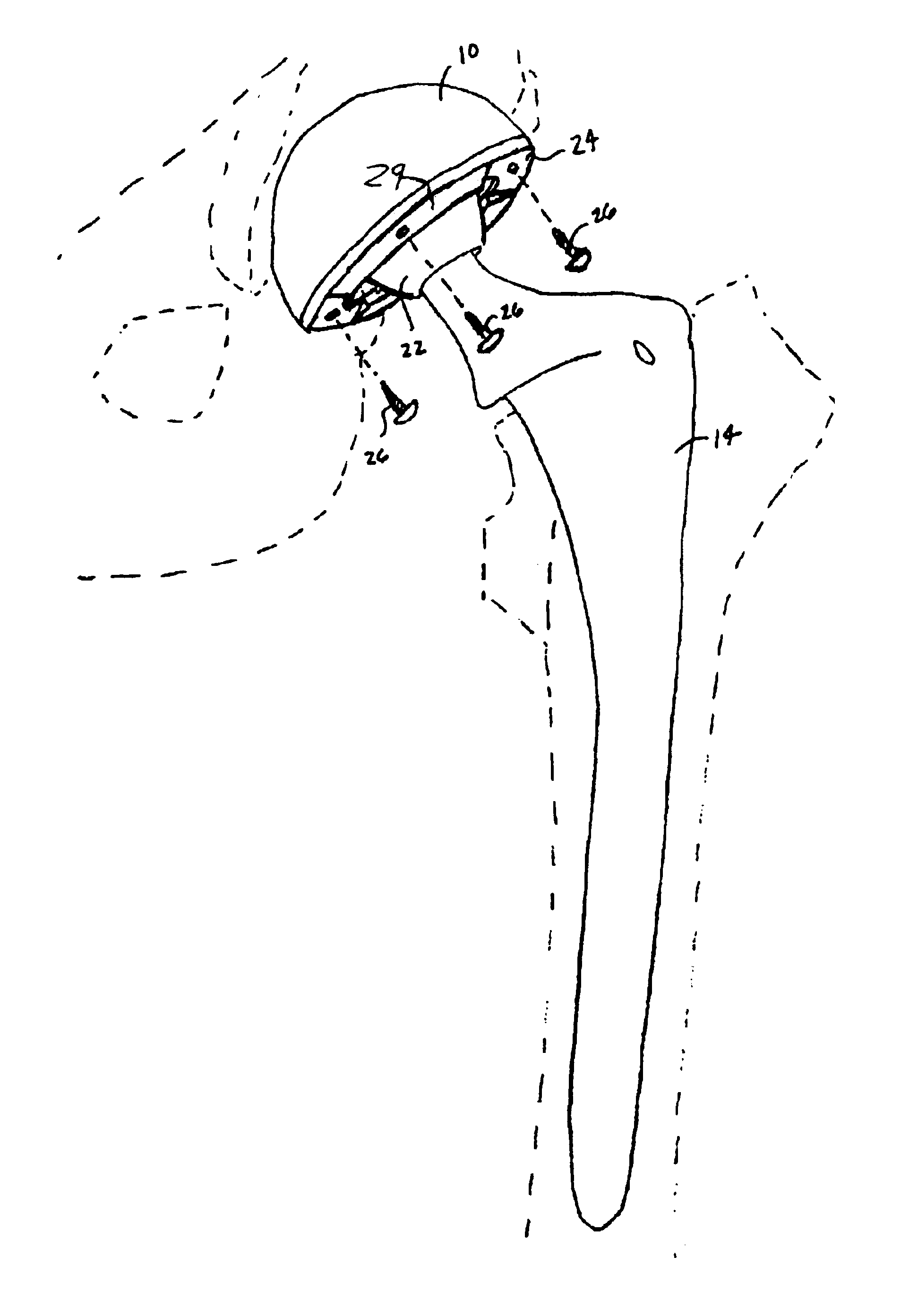Biologically reabsorbable acetabular constraining components and materials for use with a hip replacement prosthesis and bioreabsorbable materials to augment hip replacement stability and function