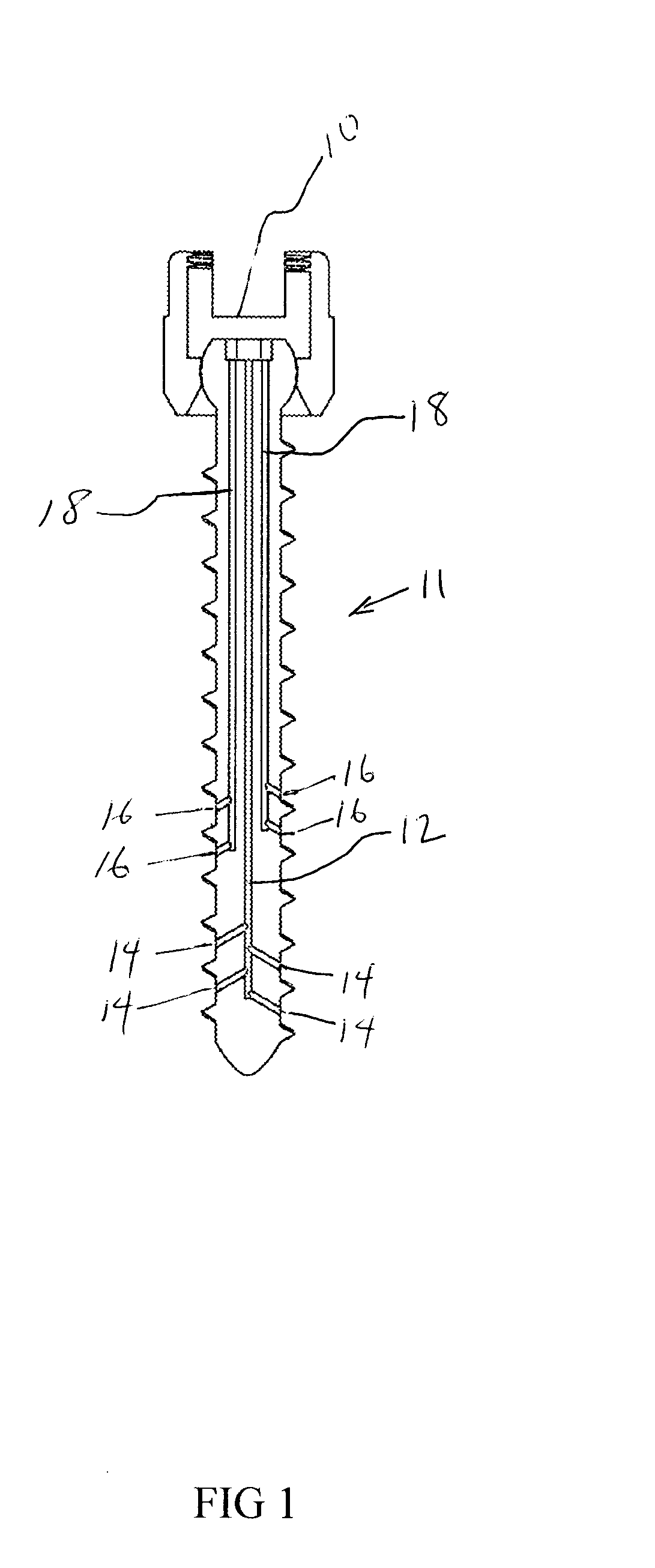 Venting/pressure adjustment to aid in delivery of material into an anatomic region via a cannula