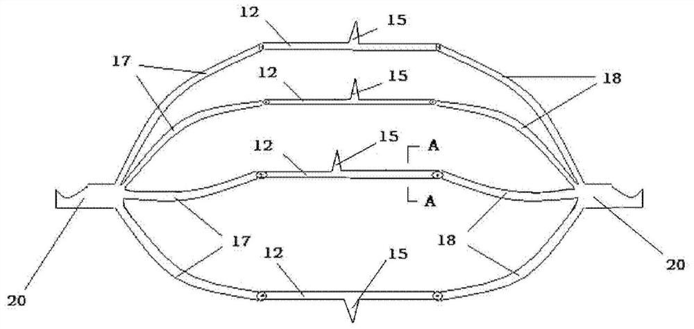 intravascular filter