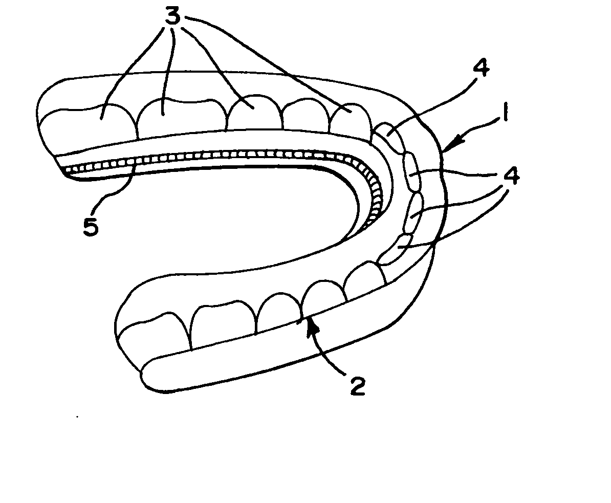 Upper and a lower single preformed and/or customized appliance and a method for attaching the appliance to a first area of a dentition and moving teeth at a second area of the dentition