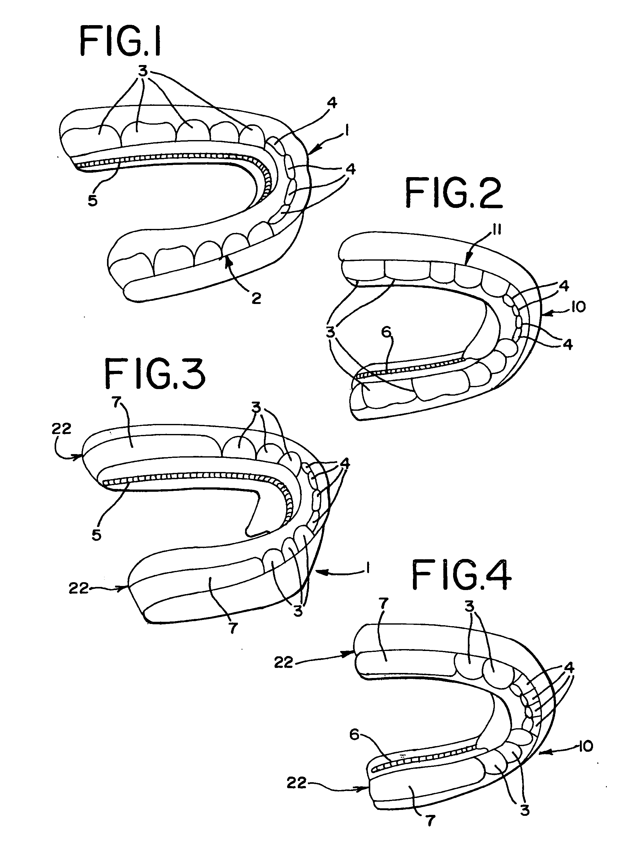 Upper and a lower single preformed and/or customized appliance and a method for attaching the appliance to a first area of a dentition and moving teeth at a second area of the dentition