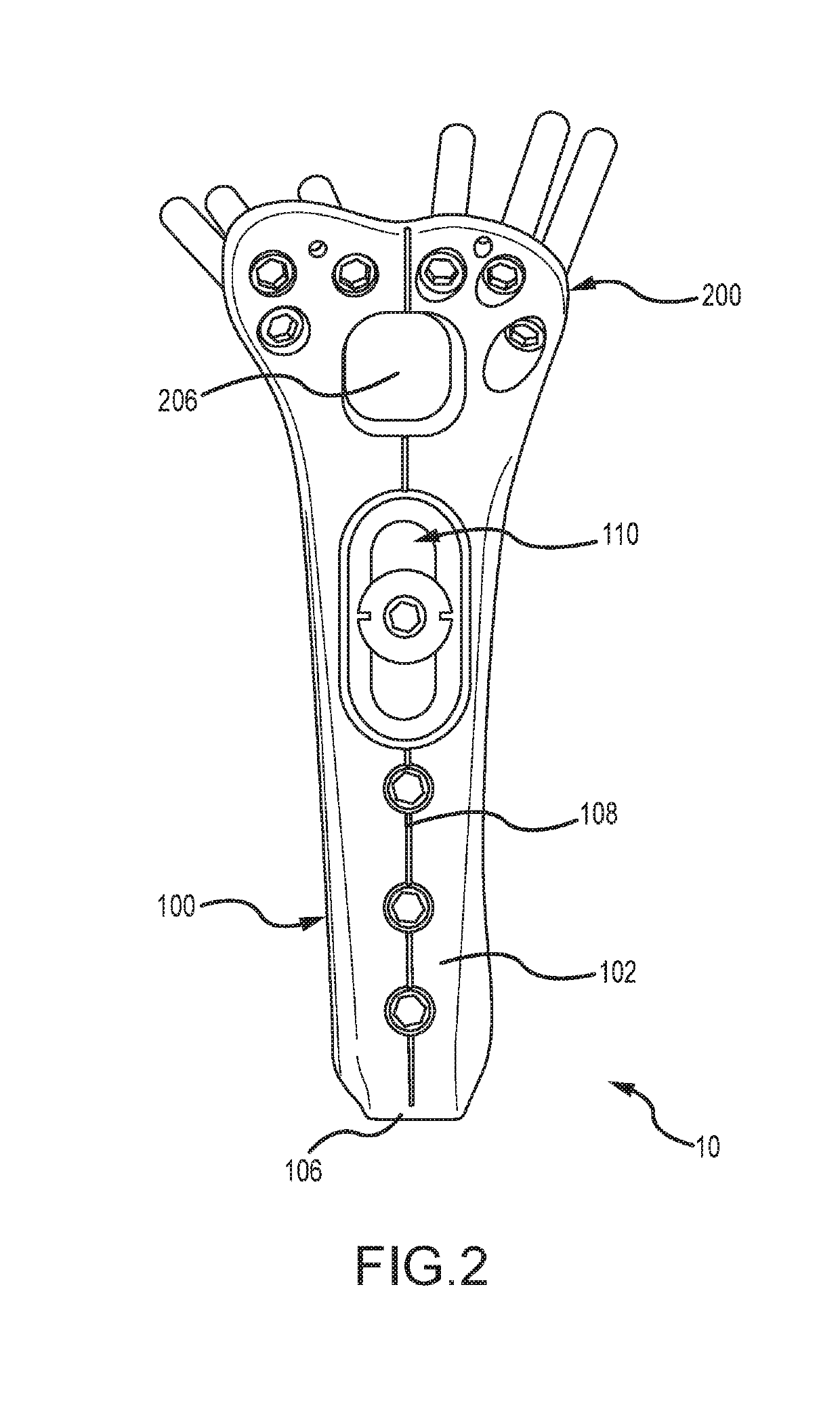 Distal radius plate