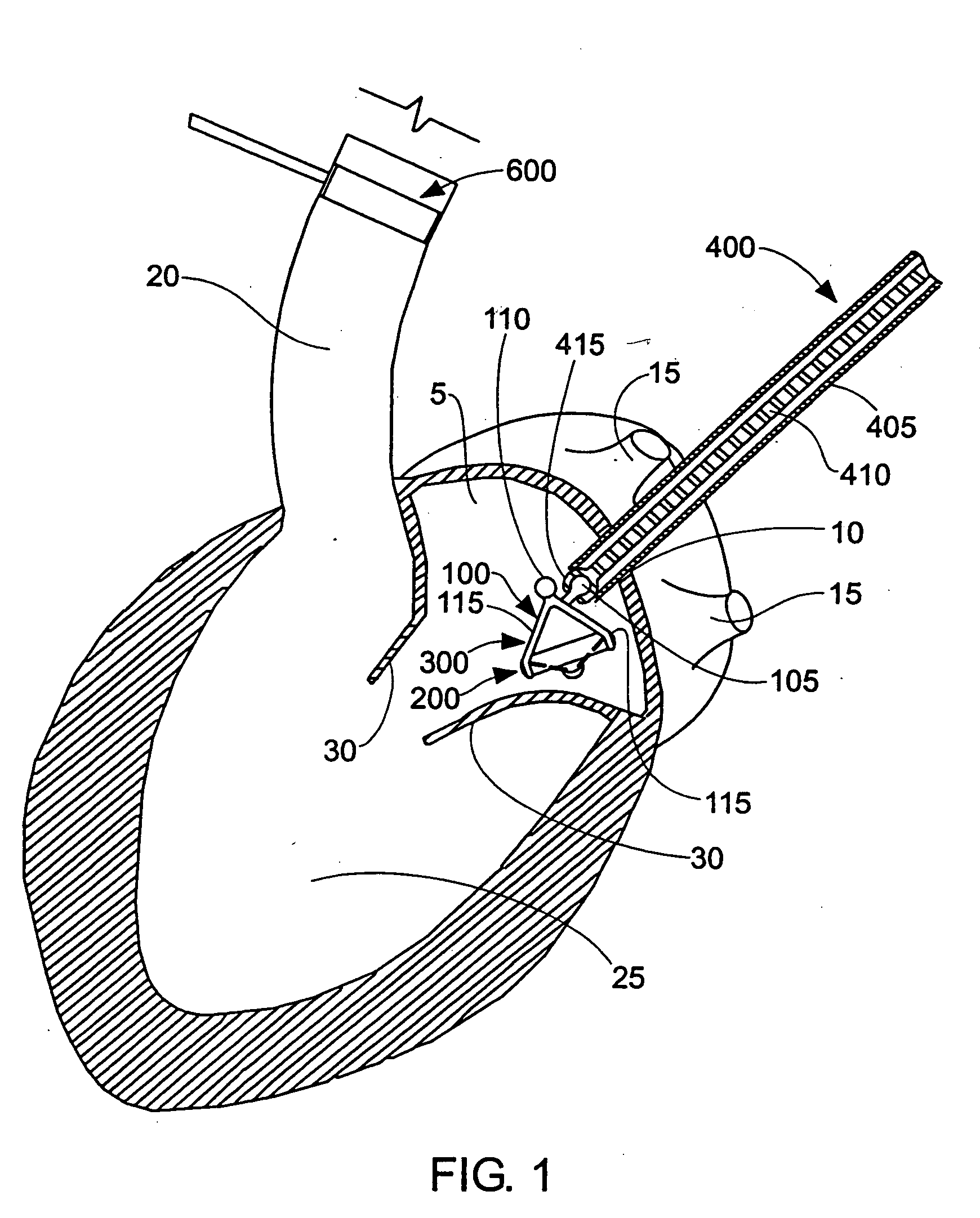 Method and apparatus for resecting and replacing an aortic valve