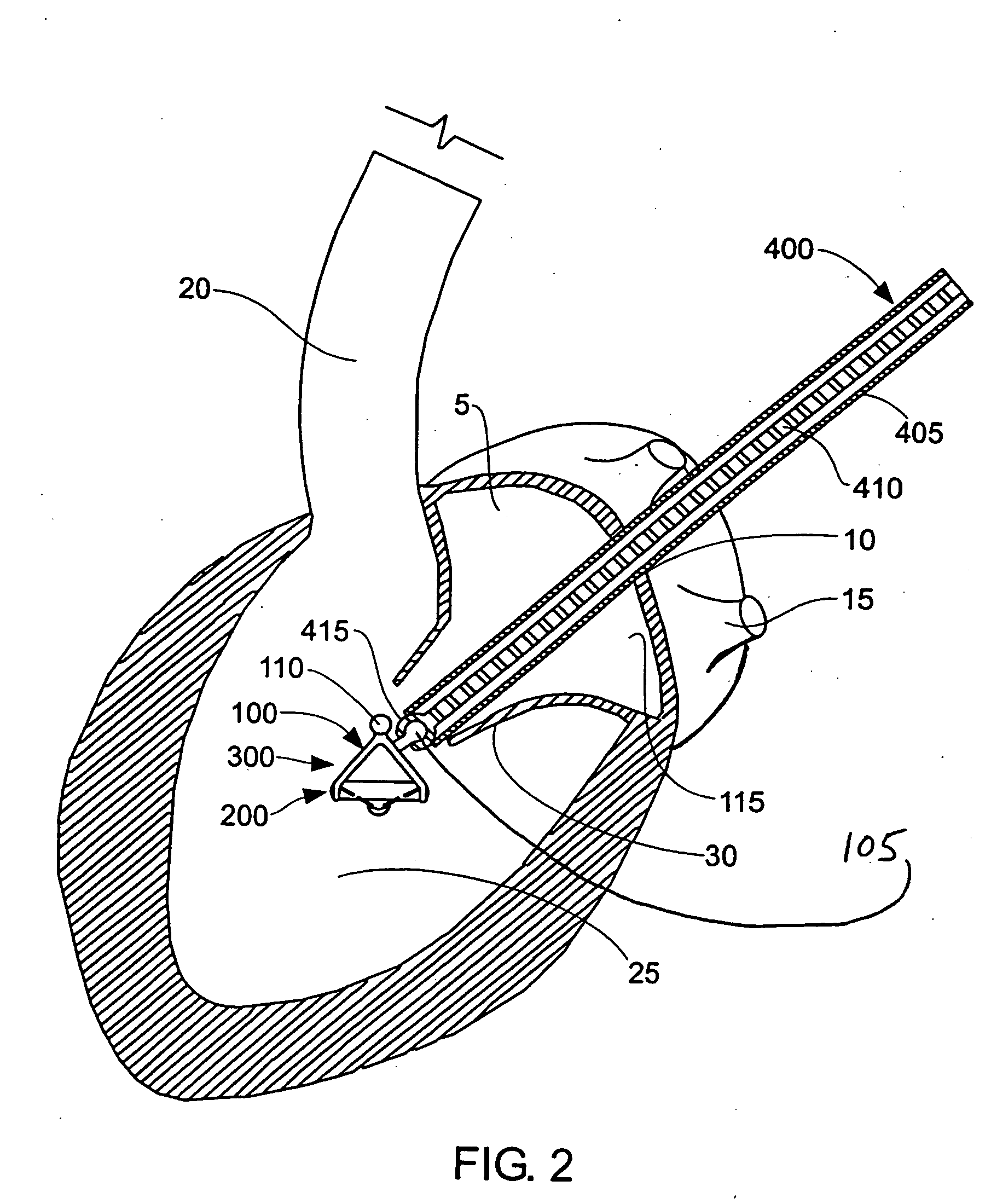 Method and apparatus for resecting and replacing an aortic valve