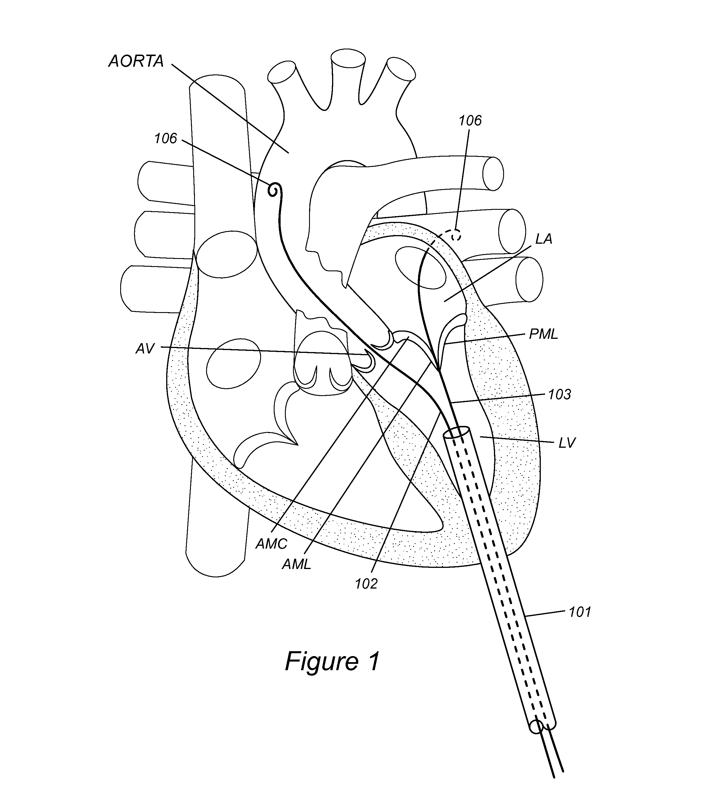 Anatomically-orientated and self-positioning transcatheter mitral valve