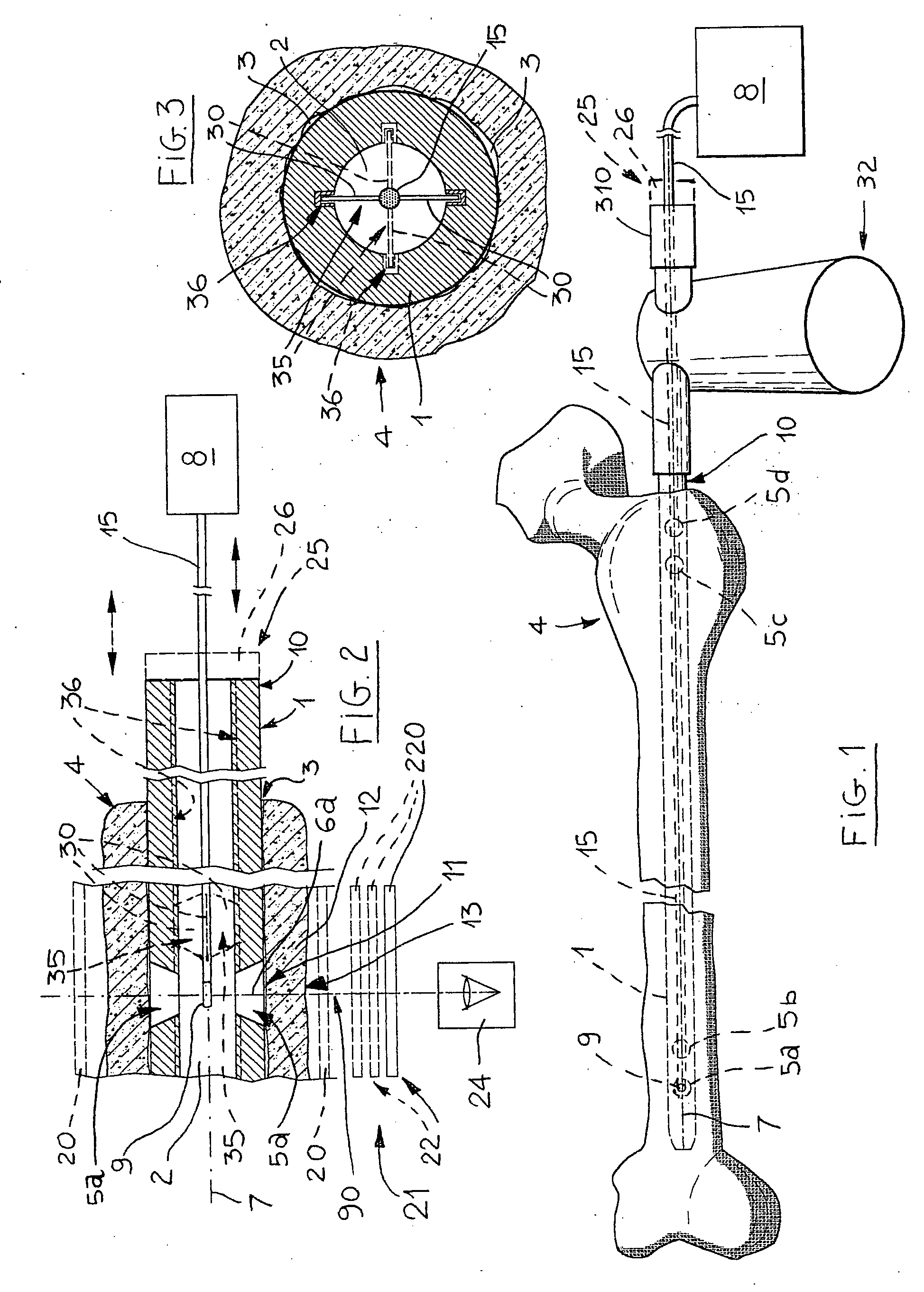 Apparatus for the osteosynthesis of bone fractures by means of locked endomedullary nailing