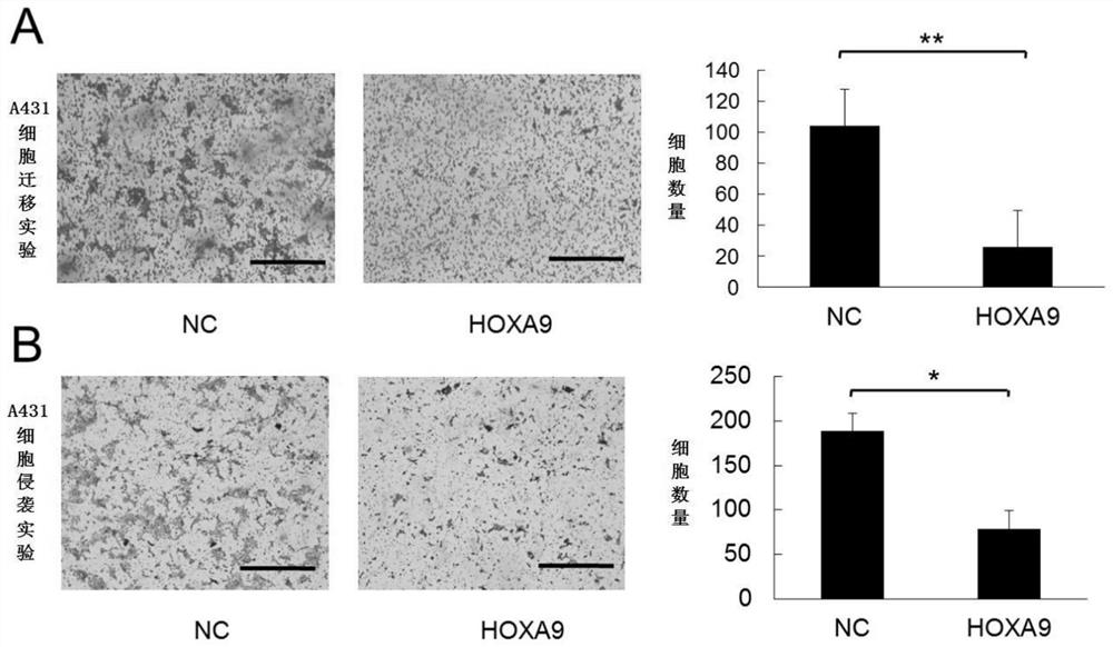 Application of hoxa9 gene in preparation of medicine for treating skin squamous cell carcinoma