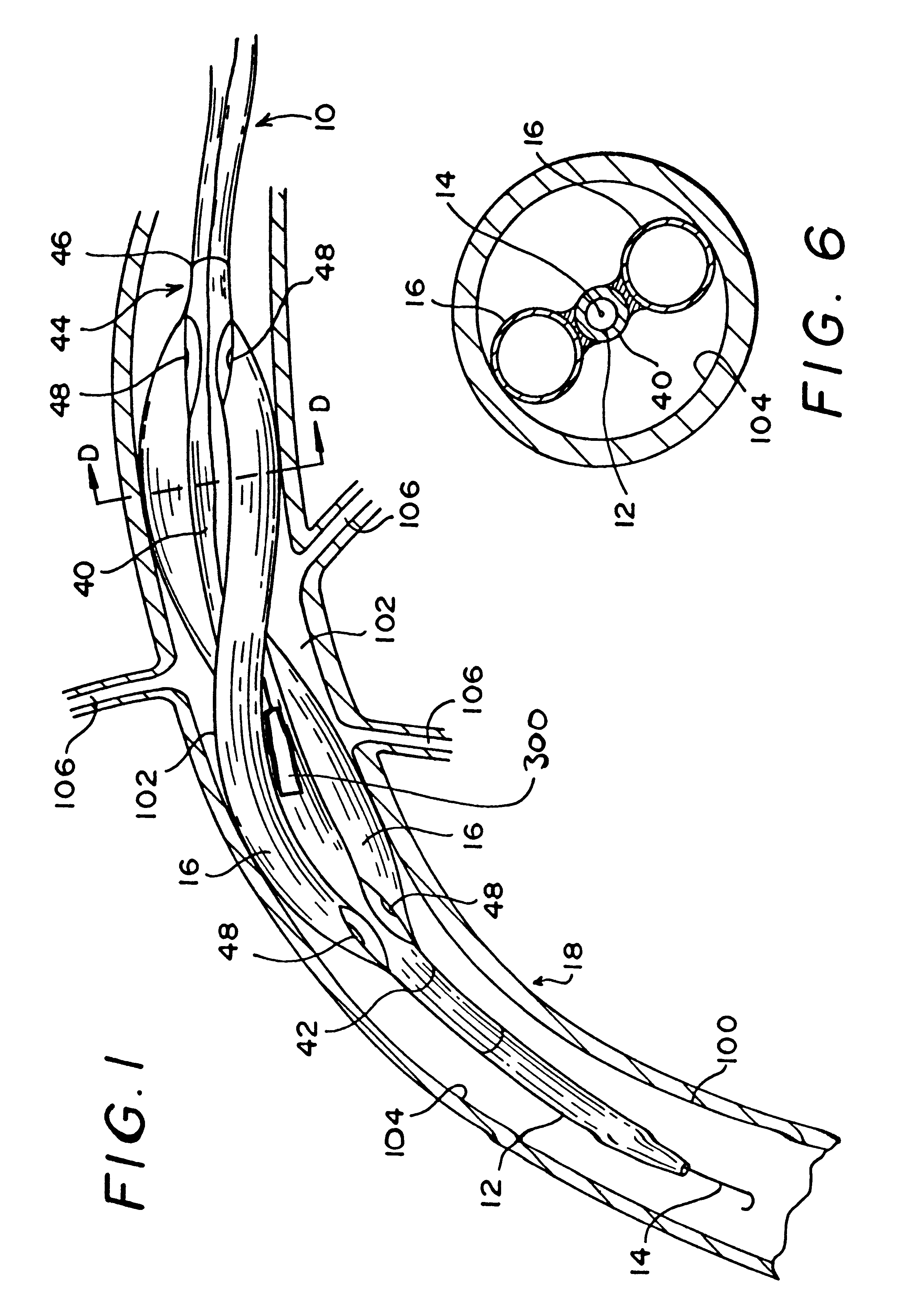 Helical spiral balloon catheter
