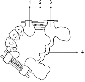 Retractor for rapid and distal movement of cuspids