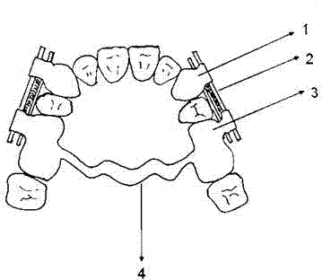 Retractor for rapid and distal movement of cuspids