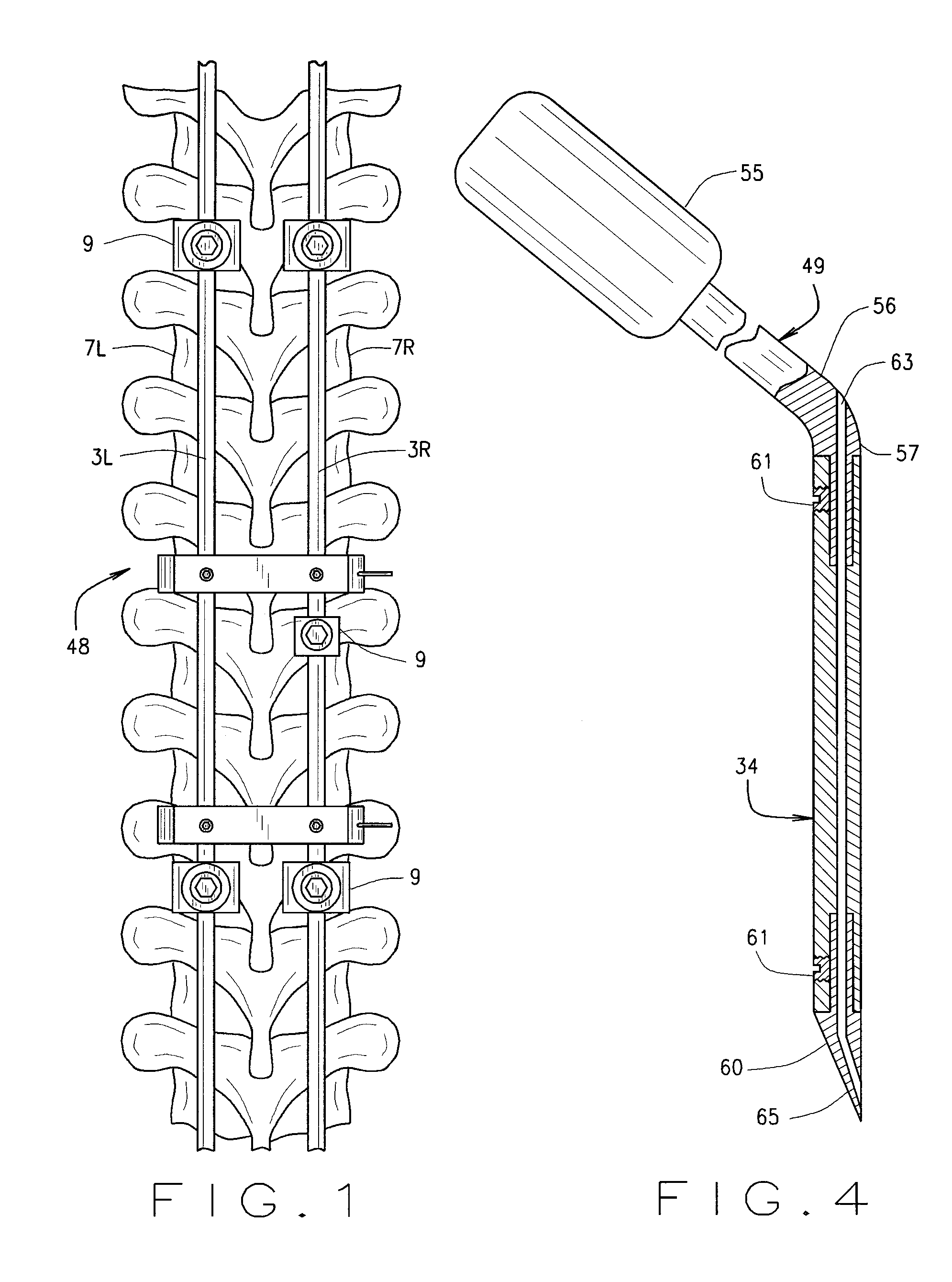 Spine Surgery Device And Method