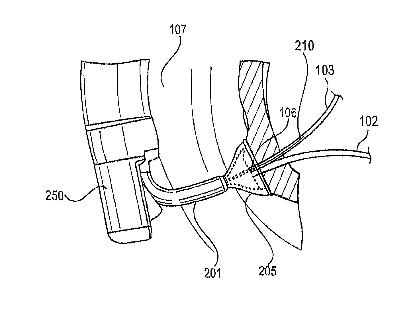 Vacuum-assisted pancreaticobiliary cannulation