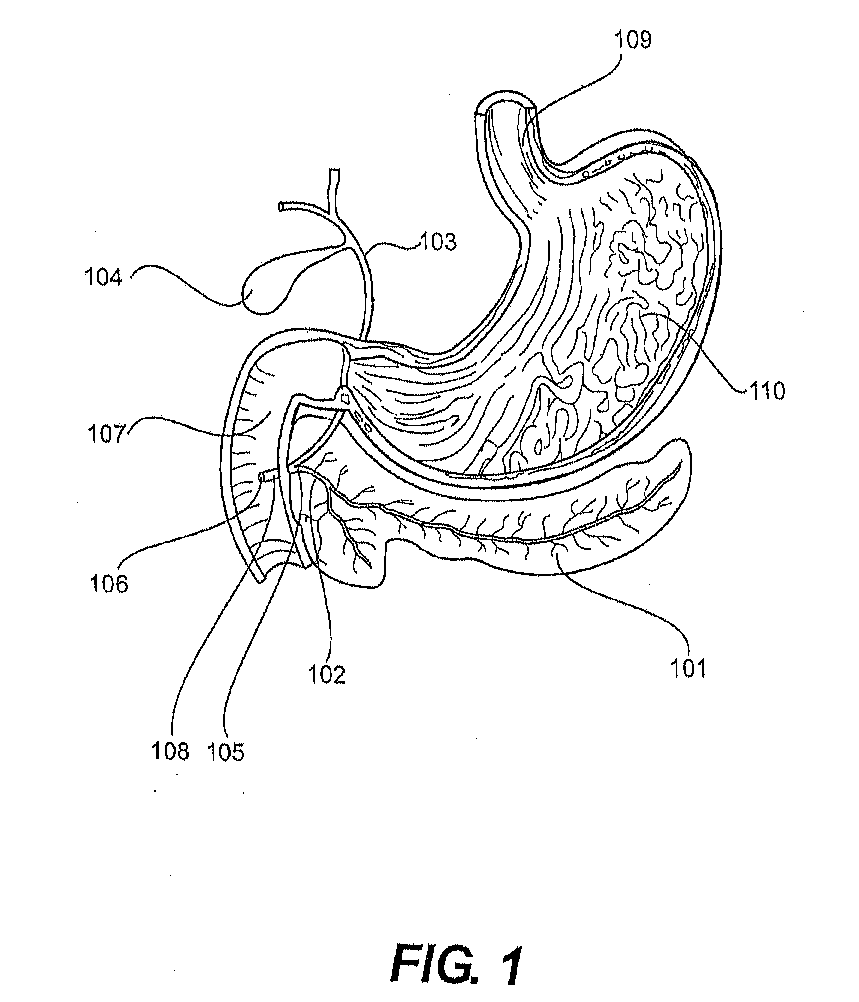 Vacuum-assisted pancreaticobiliary cannulation