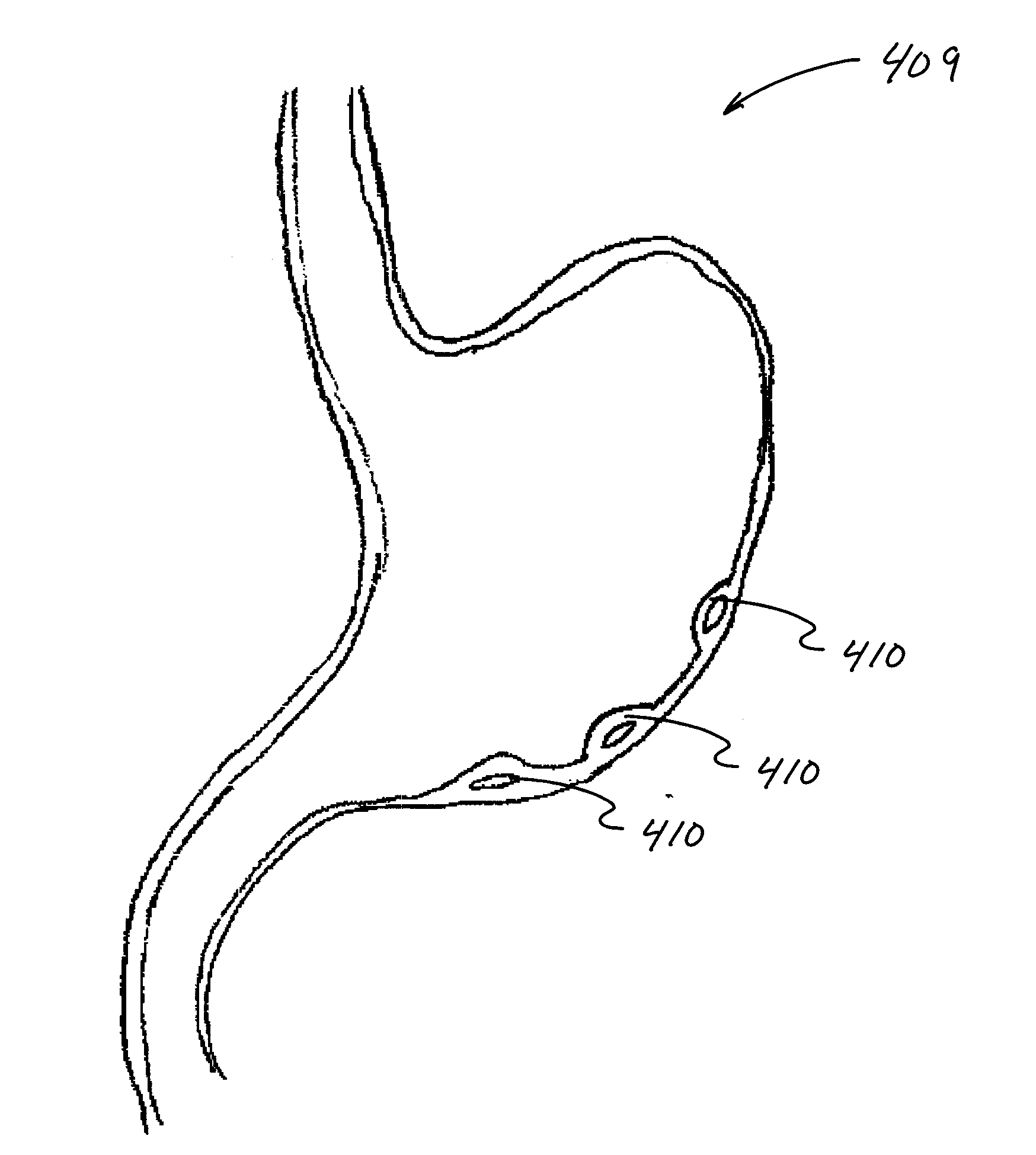 Methods and Systems for Submucosal Implantation of a Device for Diagnosis and Treatment of a Body