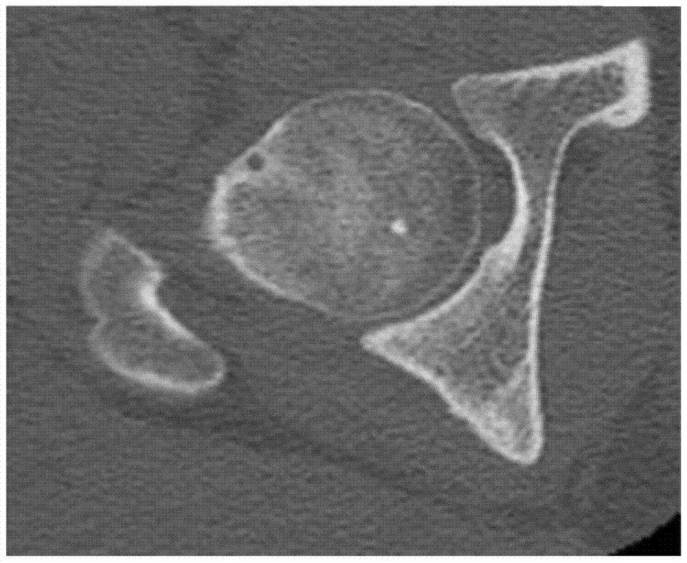 Acetabular tissue model reconstruction method for serialized hip joint CT images