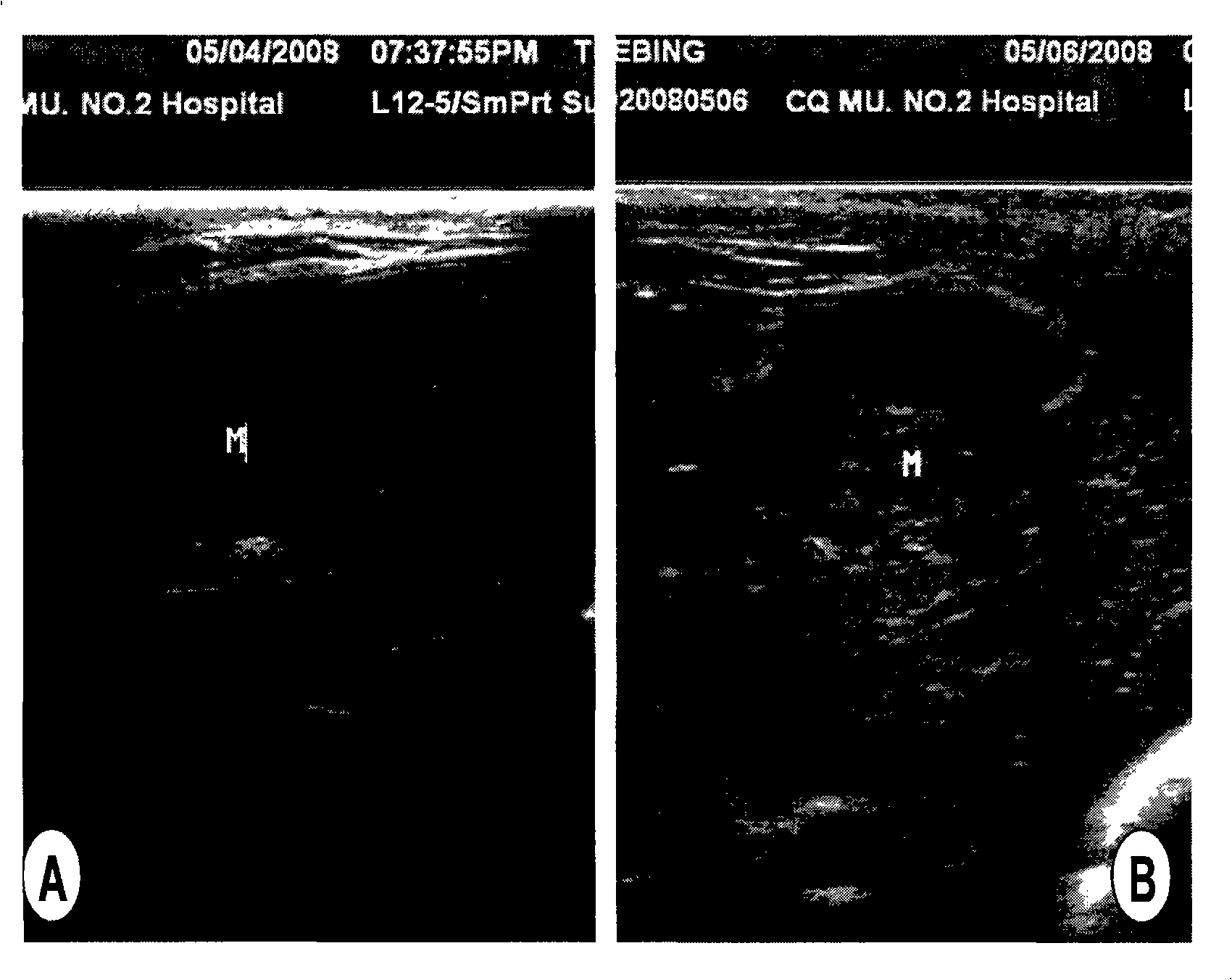 Novel targeted microbubble contrast medium