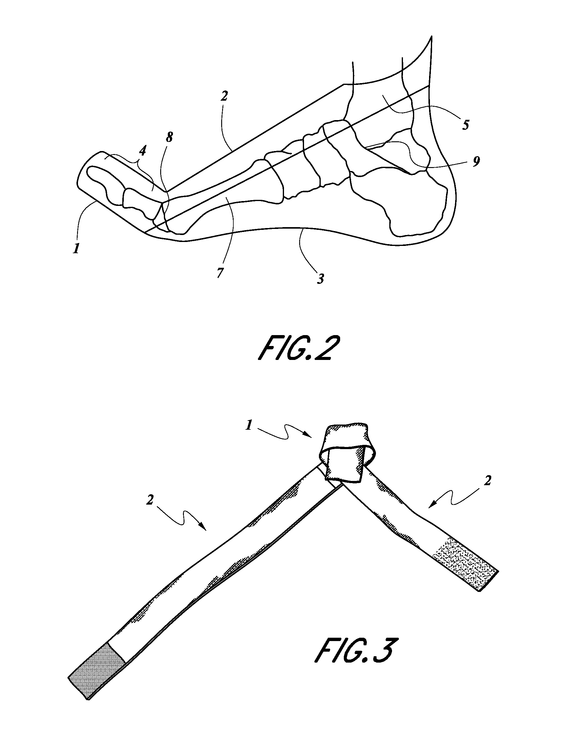 Dynamic hallux tension device for treatment of plantar fasciitis