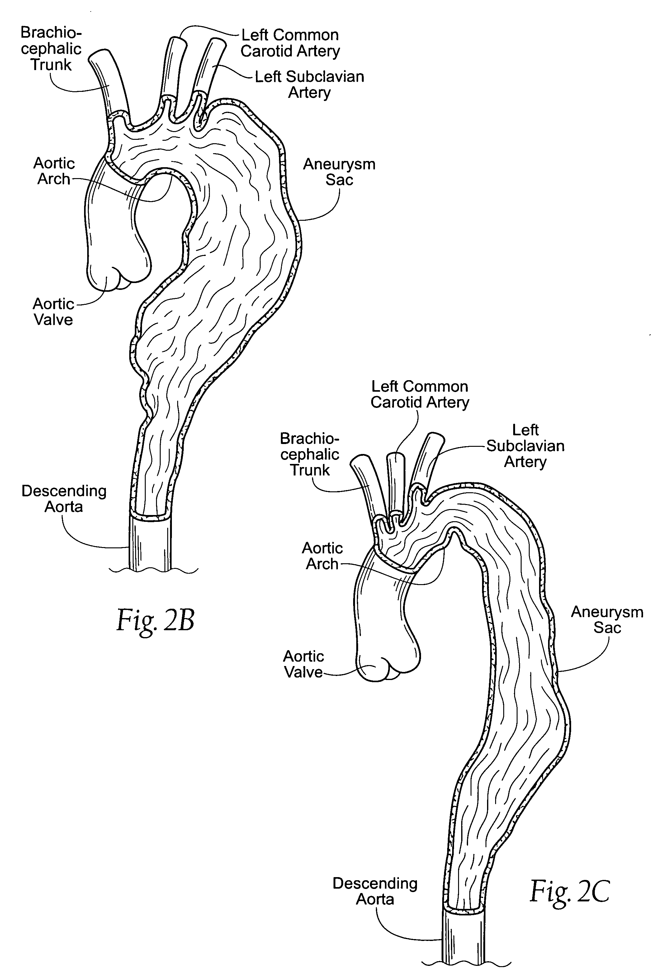 Devices, systems, and methods for endovascular staple and/or prosthesis delivery and implantation