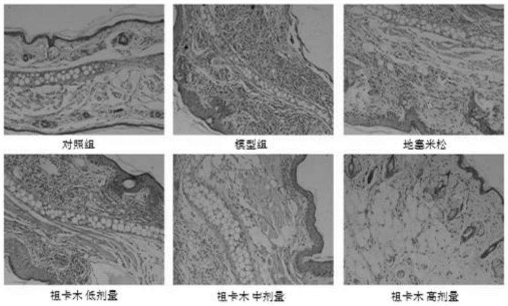 Application of Zukamu granules in lung injury caused by cytokine storm