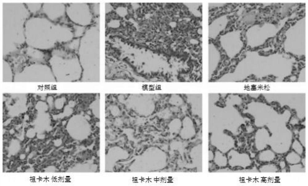 Application of Zukamu granules in lung injury caused by cytokine storm