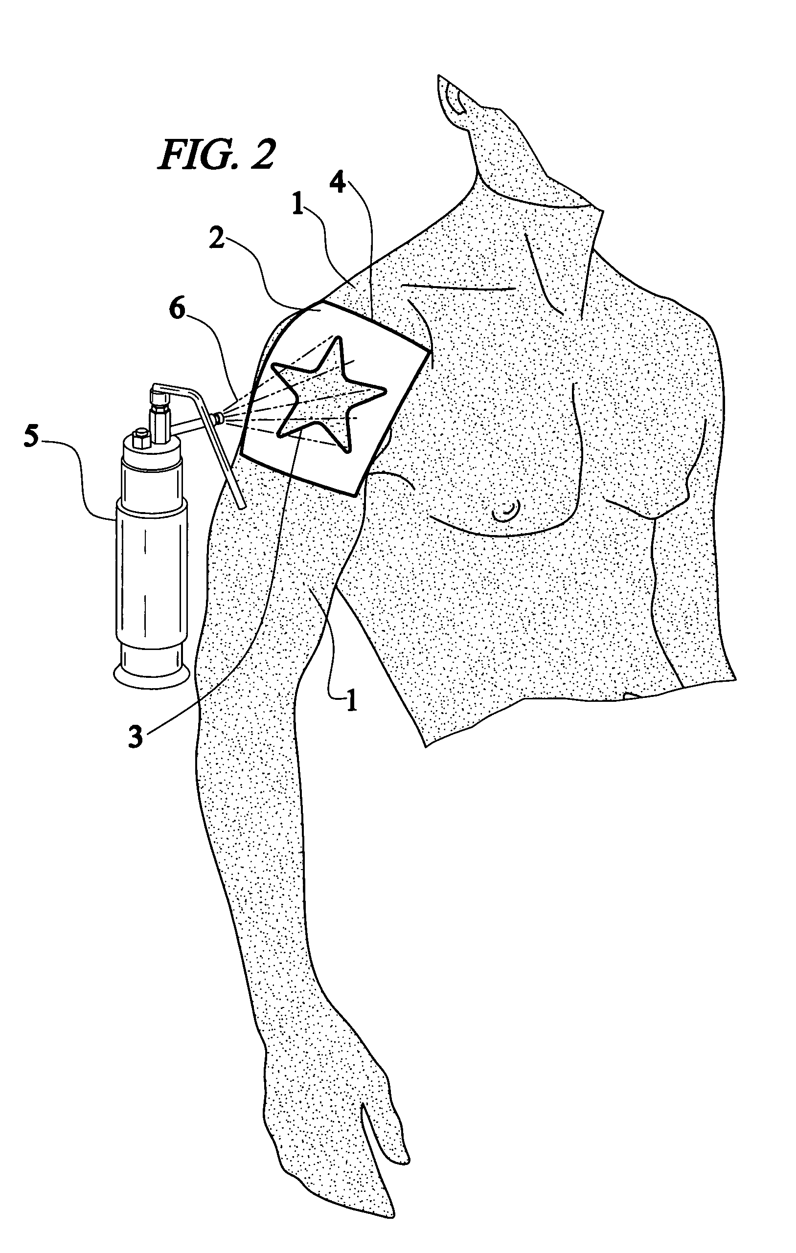 Method for producing a permanent or nearly permanent skin image, design or tattoo by freezing the skin