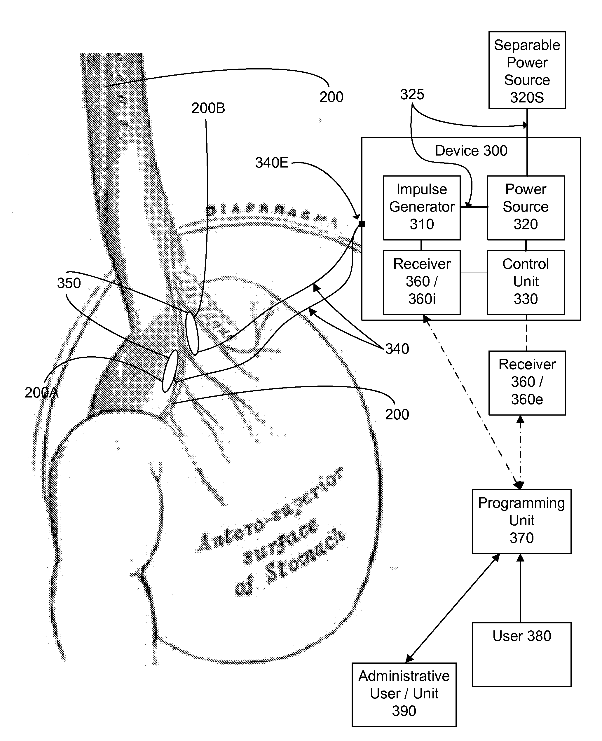 Methods and apparatus for the treatment of eating disorders using electrical impulse intervention