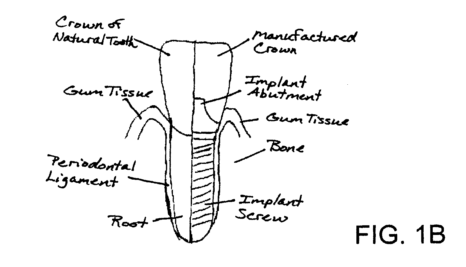 System, Method And Apparatus For Tooth Implant Planning And Tooth Implant Kits
