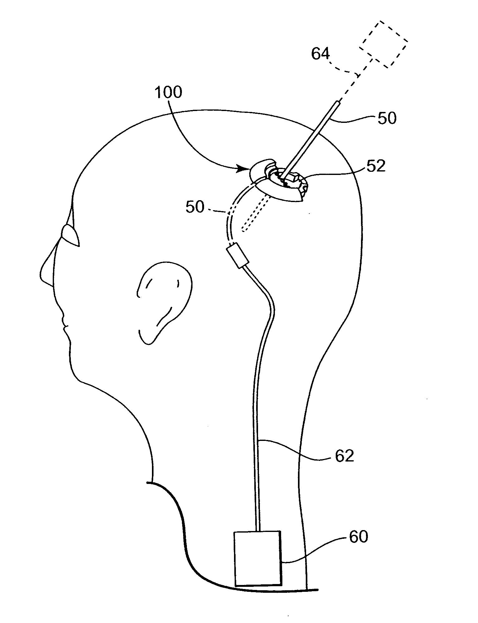 Methods and apparatus for securing a therapy delivery device within a burr hole