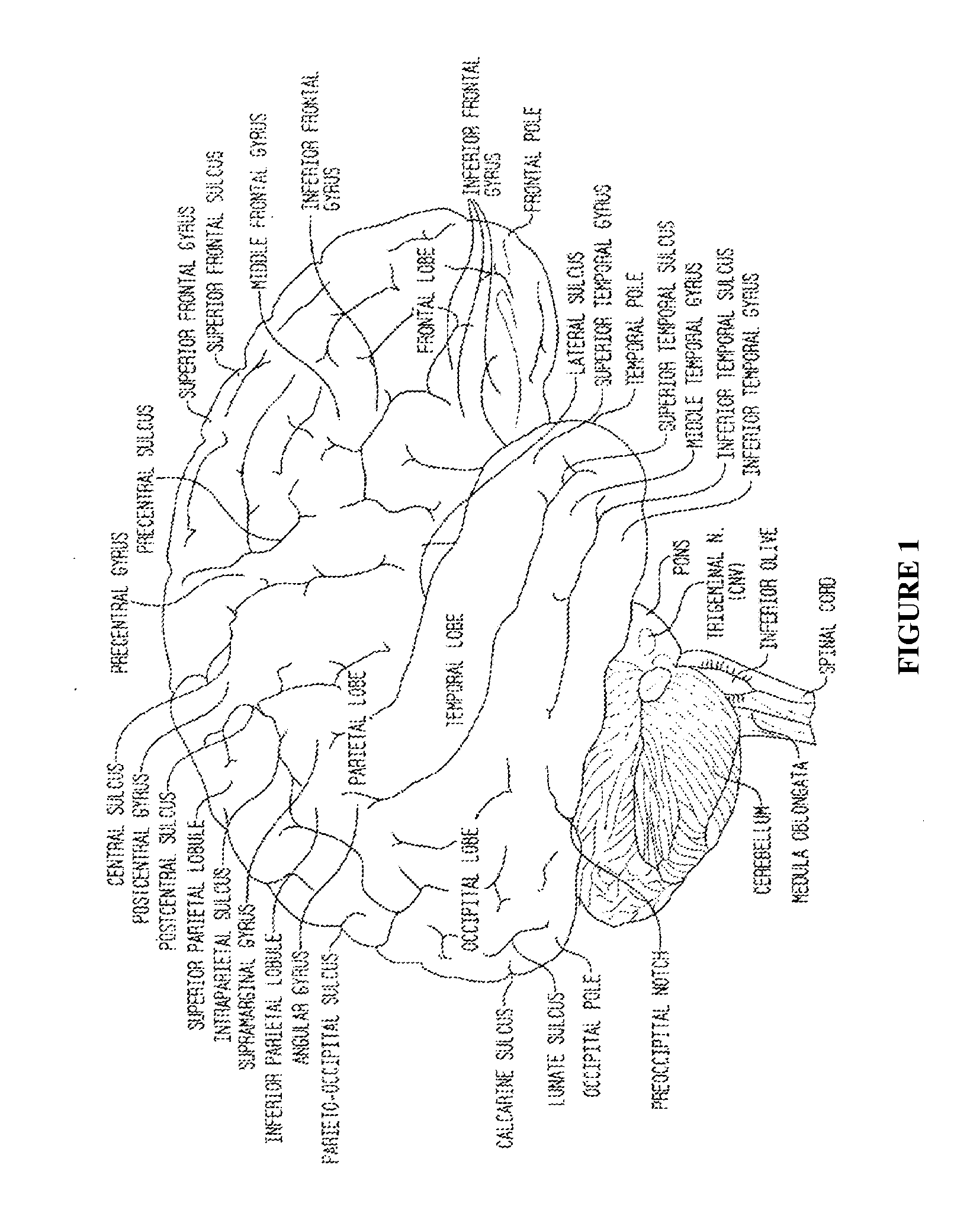 Compositions and their use to treat complications of aneurysmal subarachnoid hemmorrhage