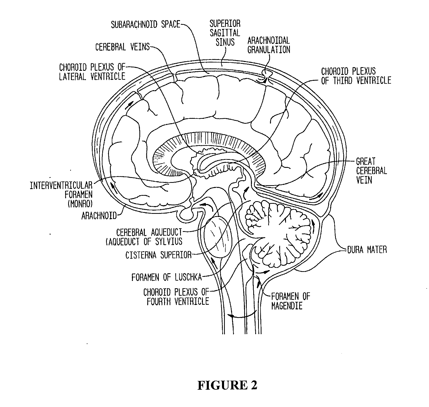 Compositions and their use to treat complications of aneurysmal subarachnoid hemmorrhage