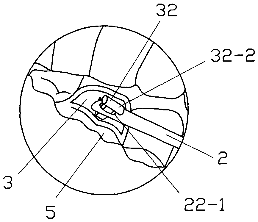 Tongue back elastic traction device and implantation method
