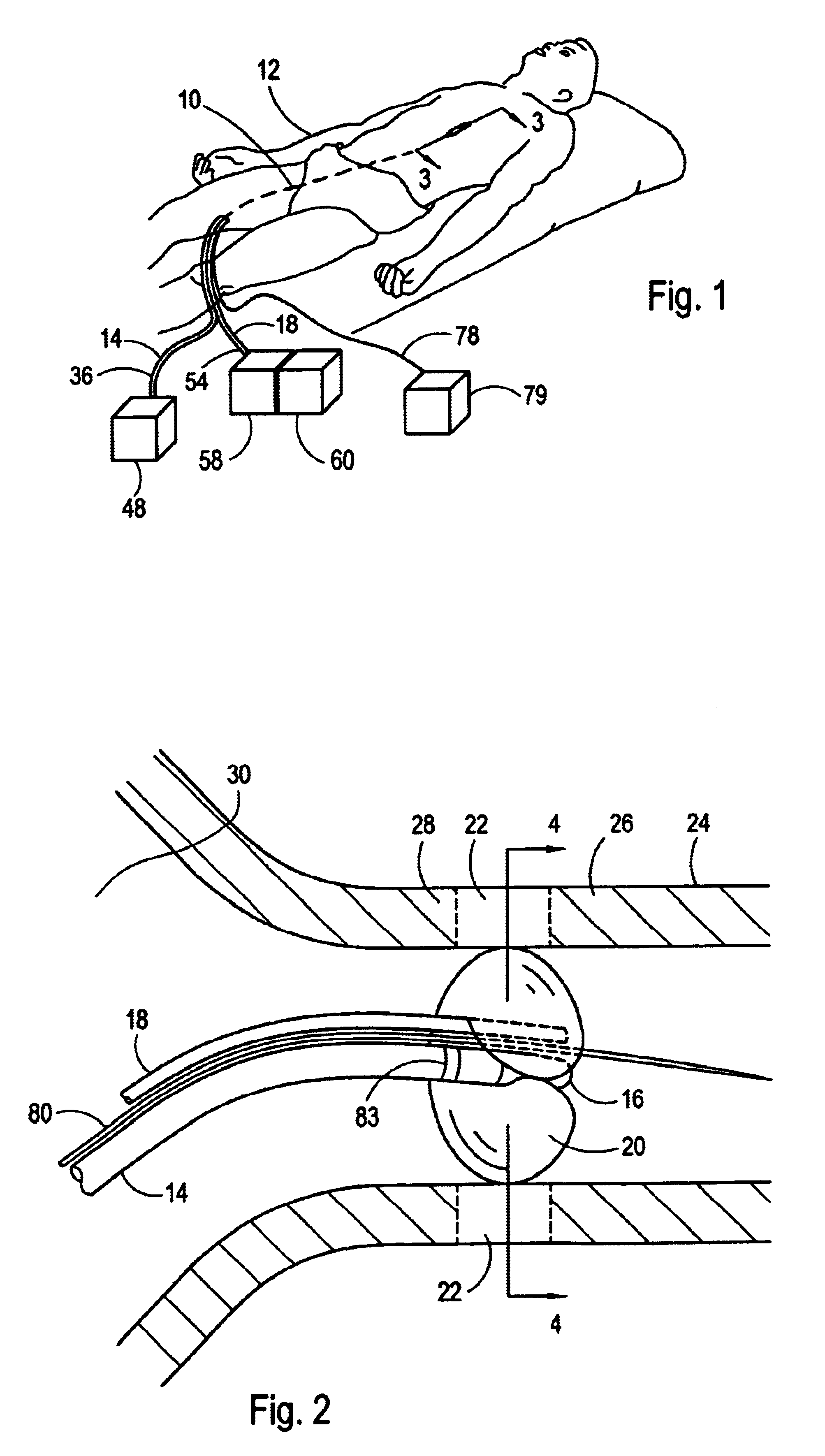 System and method for performing a single step cryoablation