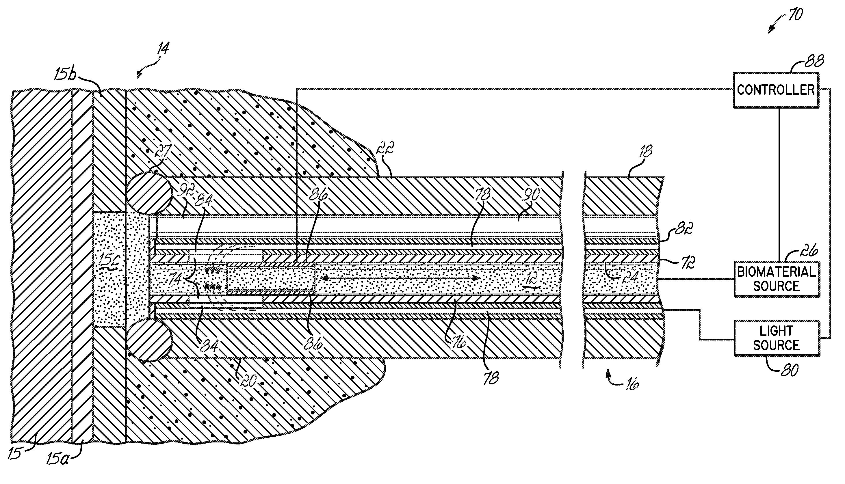 Apparatus and method for delivering a biocompatible material to a surgical site