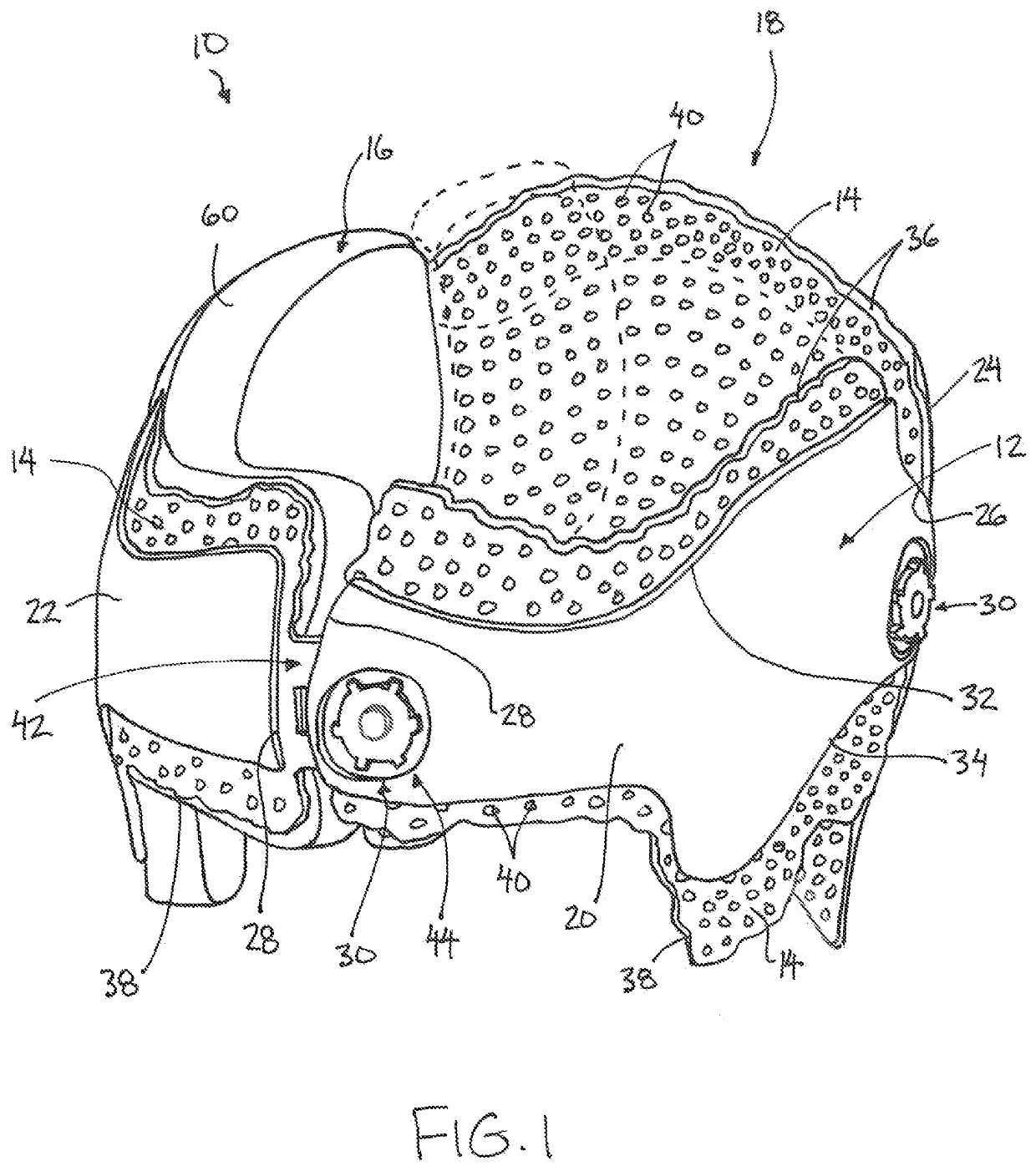 Prefabricated Customizable Cranial Remodelling Orthotic