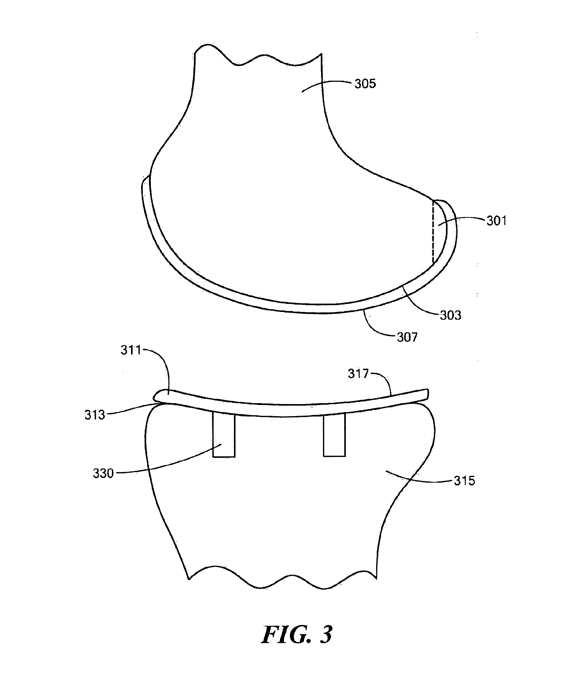 Implant Device and Method for Manufacture
