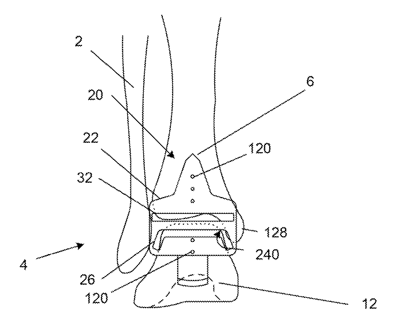 Methods and devices for deploying biological implants
