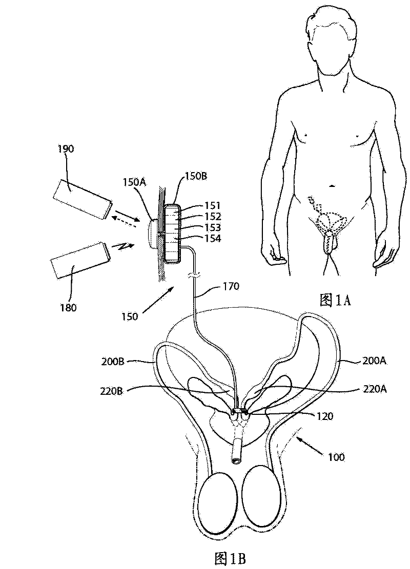 An apparatus for temporary male contraception