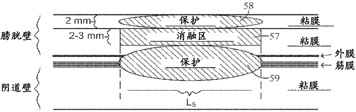 Device and method for modulating pelvic nerve tissue