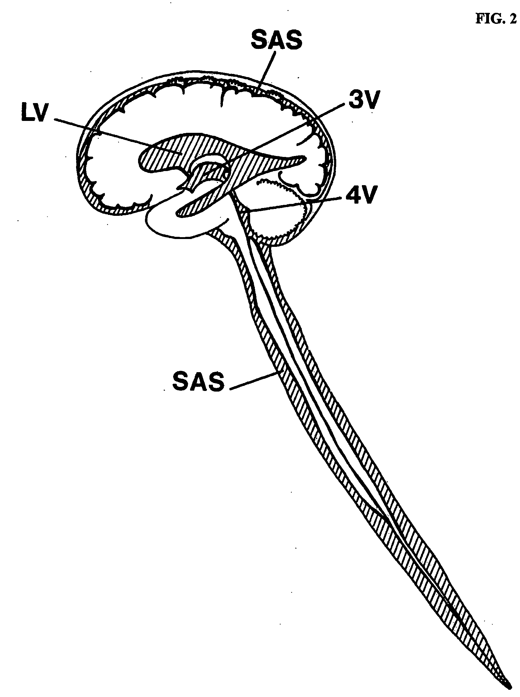 Systems and methods for CSF drainage