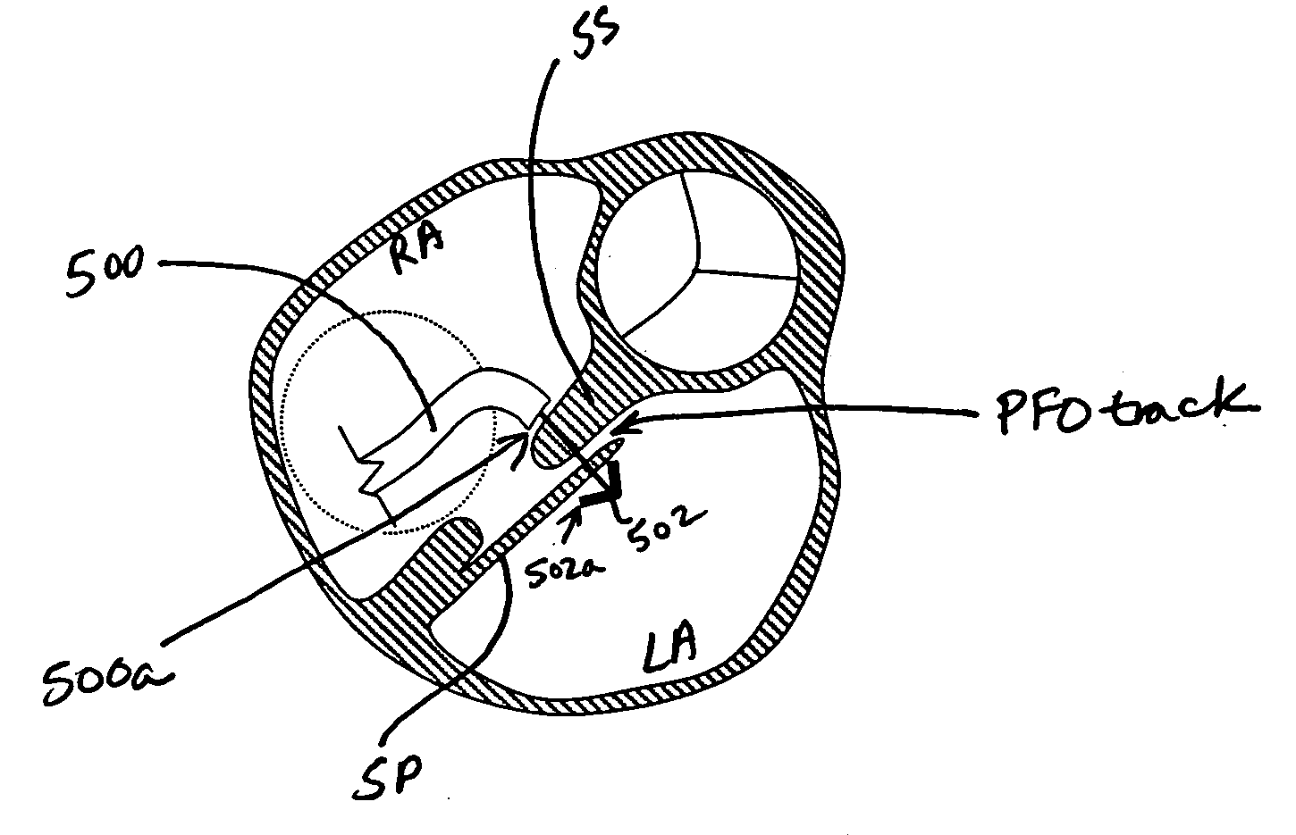 PFO closure devices and related methods of use