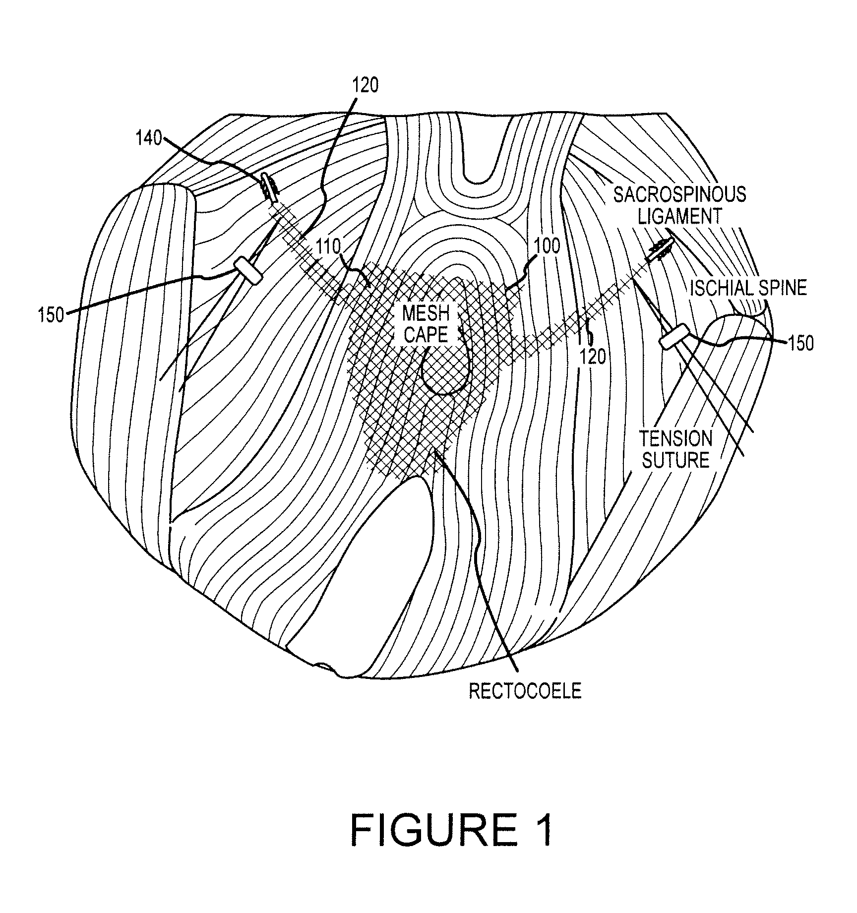 Systems and methods for treating posterior pelvic organ prolapse