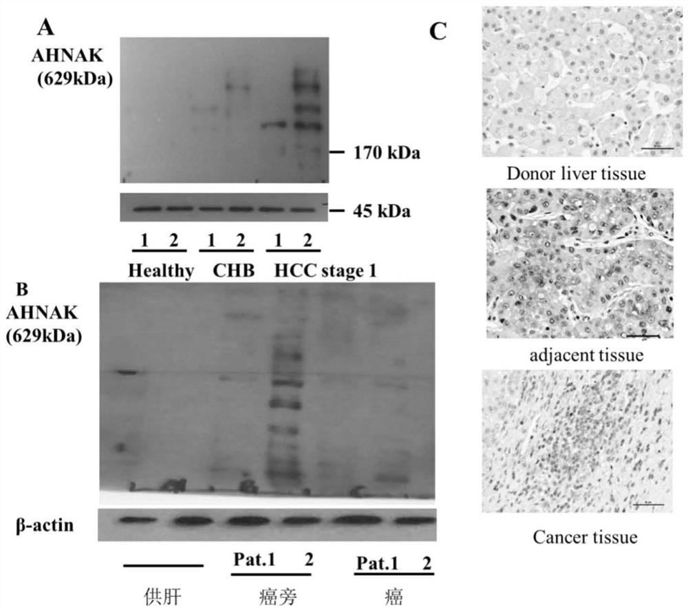 Application of AHNAK in inhibiting generation of drug resistance of EGFR-TKI drug in HCC