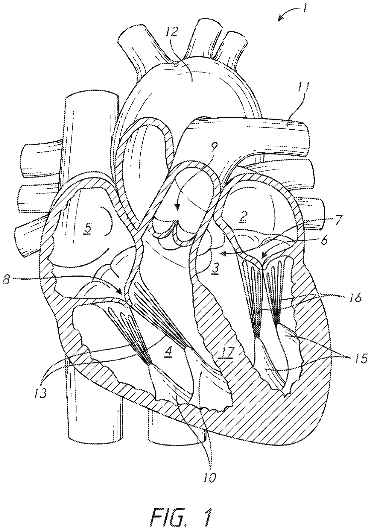 Spring and coil devices for papillary muscle approximation and ventricle remodeling