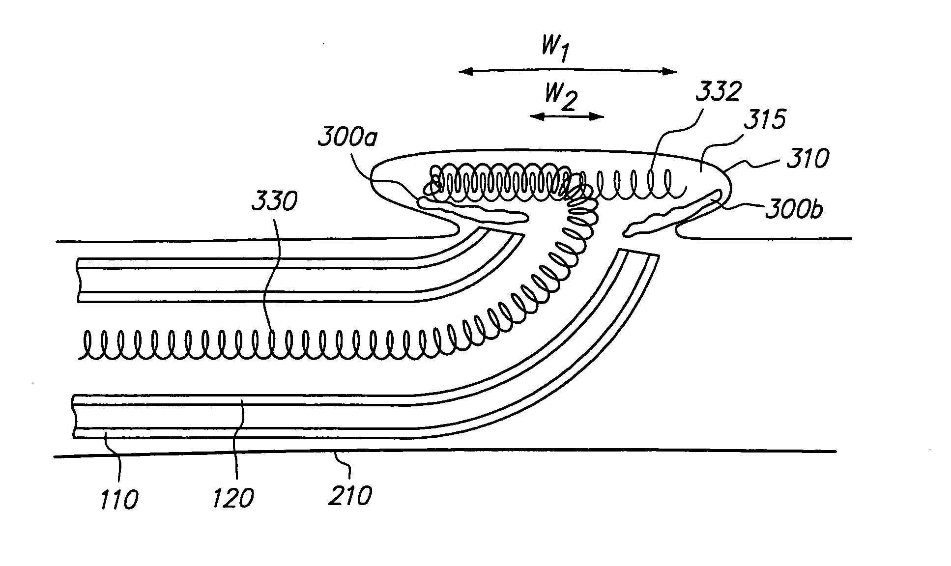 Method and system for delivering an implant utilizing a lumen reducing member
