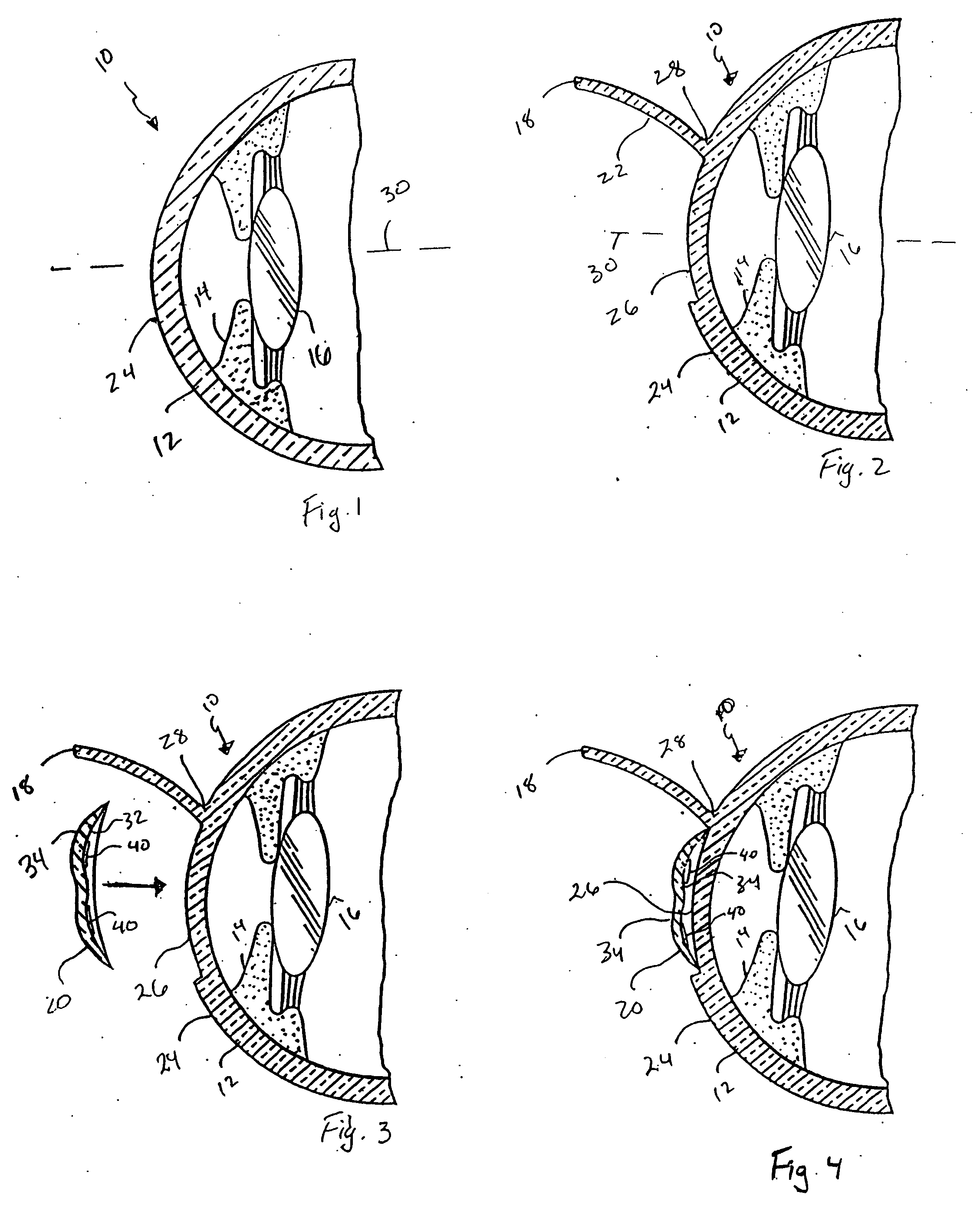 Device and method for reshaping the cornea