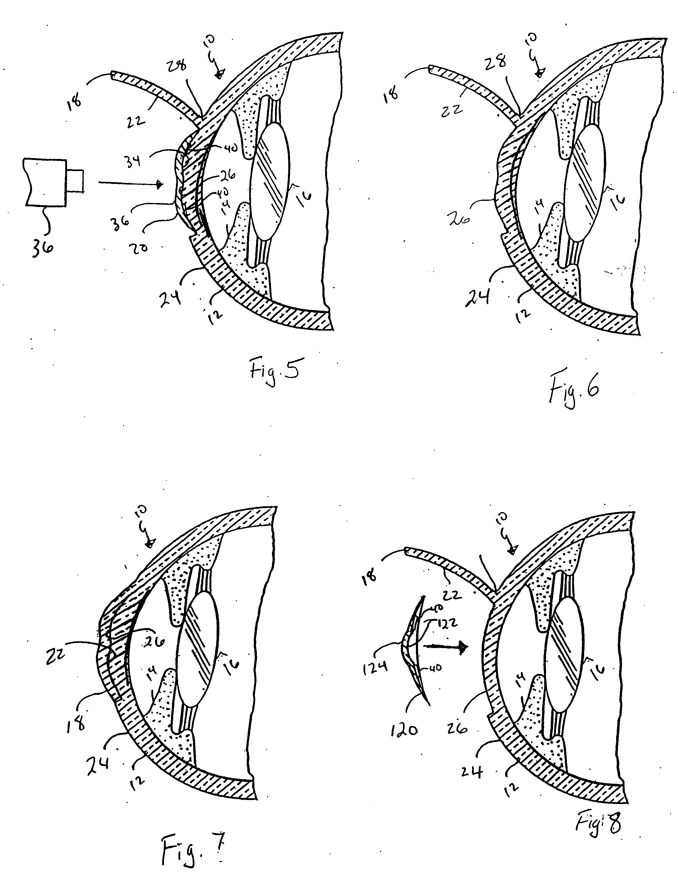 Device and method for reshaping the cornea