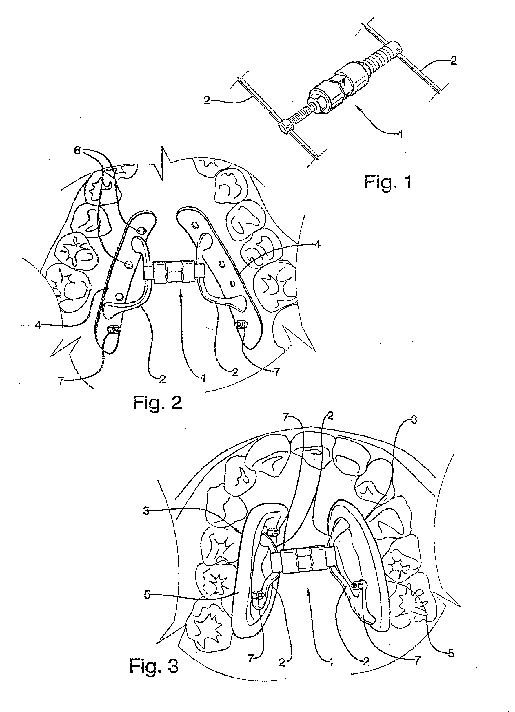 Dental device for correcting upper jaw transversal micrognathism in adult patients and procedure for building the device and a surgical