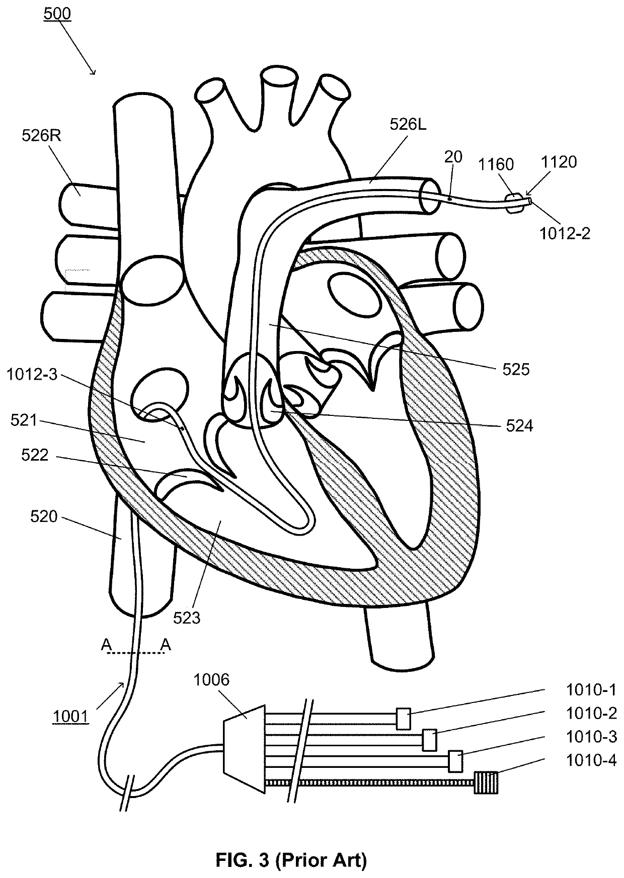System and apparatus comprising a multi-sensor catheter for right heart and pulmonary artery catheterization