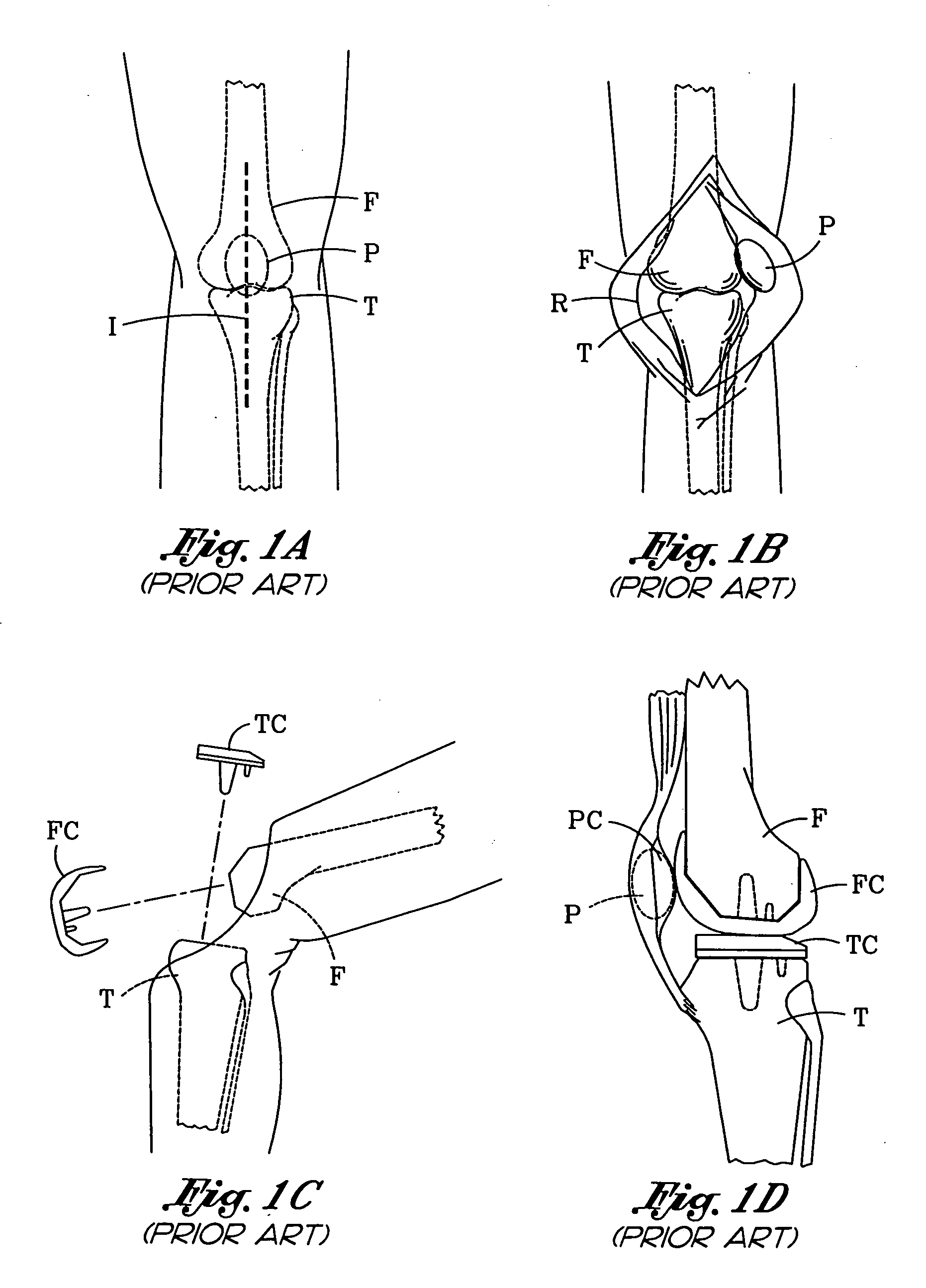 Patellar cutting guide